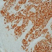 Figure 1. Formalin-fixed, paraffin-embedded human breast carcinoma stained with Heat Shock Protein 27 (Cat. #X1264M) using peroxidaseconjugate and DAB chromogen. Note intense cytoplasmic staining of tumor cells.